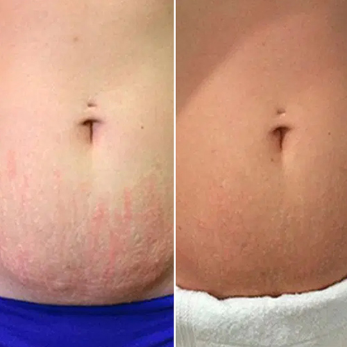 Inkless & Stretch Mark Technique 11 Training In Person Toronto Beauty Spot